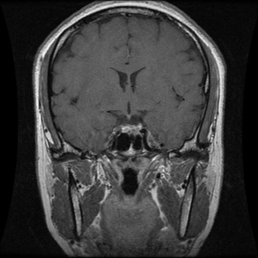 Contoh Pituitary